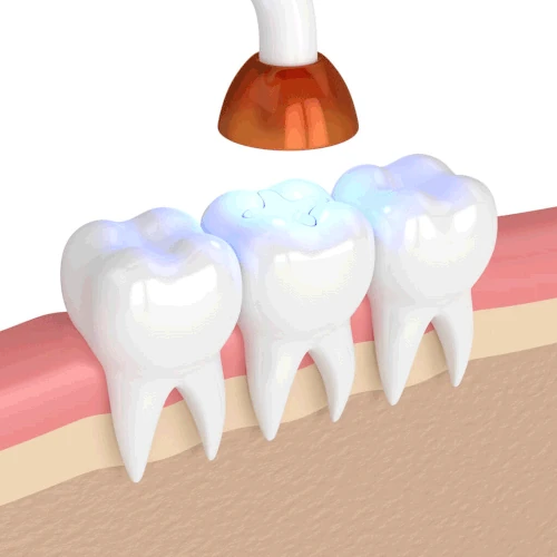 Fillings and Sealants