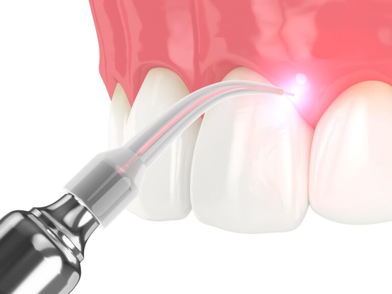 Close-up of a dental laser device emitting a focused beam onto the gums above clean white teeth; healthy pink gingiva shown during a soft tissue procedure.