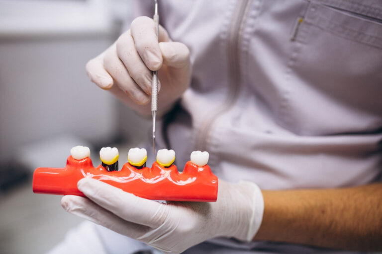 Gloved hands manipulating a red dental model with five teeth, three of which have yellow bases and black tops resembling crowns or restorations; one hand holds a dental tool, suggesting a demonstration or training procedure.
