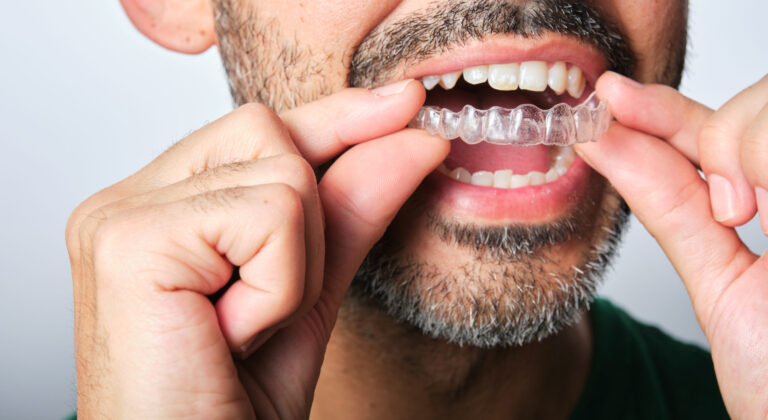 Close-up of a person inserting a transparent dental aligner over their upper teeth using both hands; teeth are visible, and the aligner fits snugly, illustrating orthodontic use.