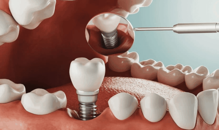 Detailed 3D rendering of a dental implant procedure on a lower jaw showing an implant post in the bone with an abutment and a crown, magnified to highlight the implant structure, against a red and cream background.