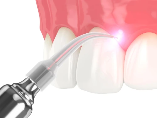 Soft tissue laser at Shine Family Dentistry in Garner, NC.
